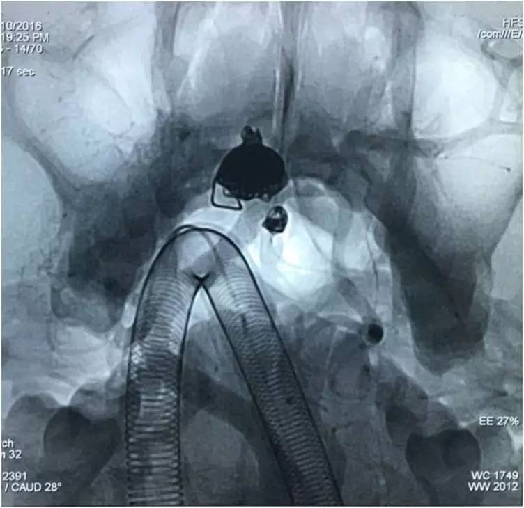 基底动脉顶端动脉瘤加左侧小脑上动脉瘤以Y型支架结合弹簧圈栓塞