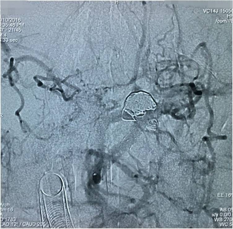 基底动脉顶端动脉瘤加左侧小脑上动脉瘤以Y型支架结合弹簧圈栓塞