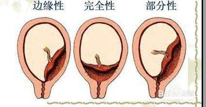 胎盘前置状态能顺产吗,发现胎盘快要植入