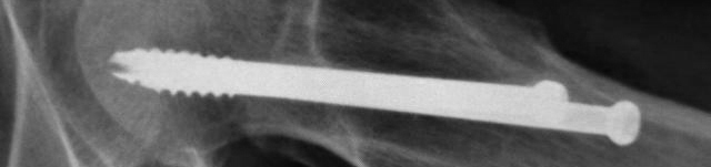 股骨颈骨折取钢钉一般休息多久,股骨颈骨折取钢钉休息多长时间