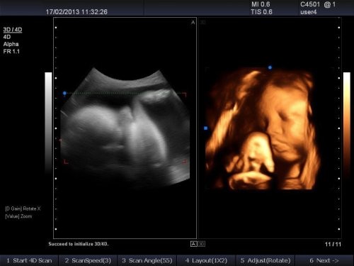 保胎保得好的医生,保胎在医院打针对胎儿有影响吗