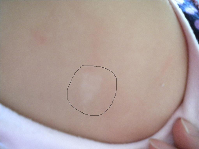 新生儿胎记种类与图片,新生儿胎记种类都有哪些