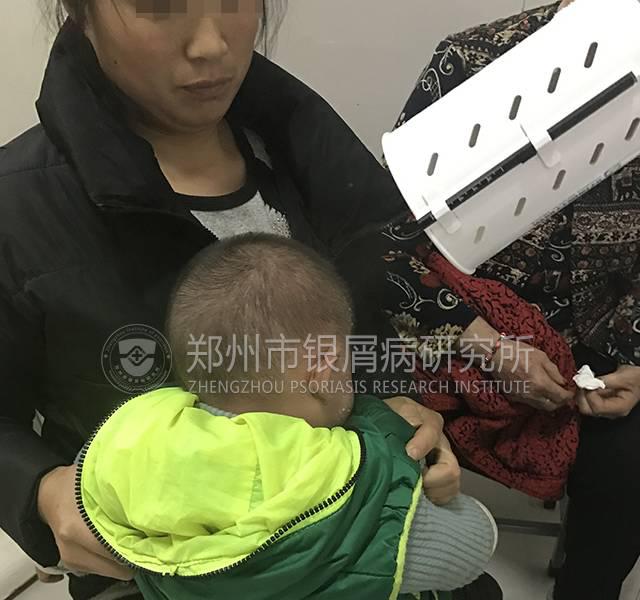 案例分享|四岁男童因误治变成沙皮人！