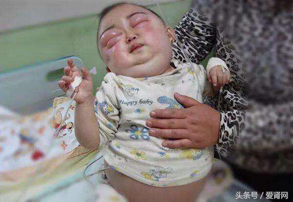 宝宝得了肾炎怎么办,孩子得了肾病要紧吗