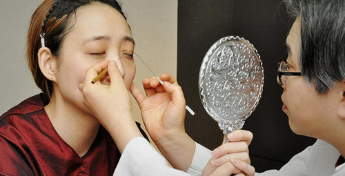 二次修复双眼皮恢复过程,二次修复双眼皮的过程