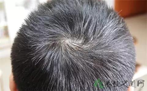 有少年白的建议染发吗,有少年白发的明星