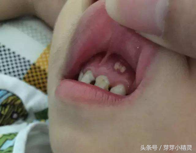 牙龈处长了不疼的小包,牙龈上起了一个小肉包的图片