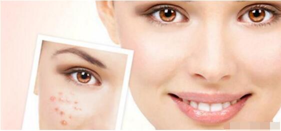 激素脸大家说怎样治愈的,激素脸要排毒表现