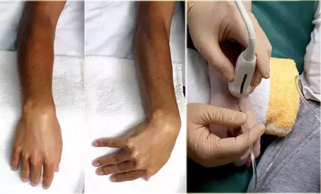 超声引导穿刺和介入穿刺的优缺点,关节超声引导