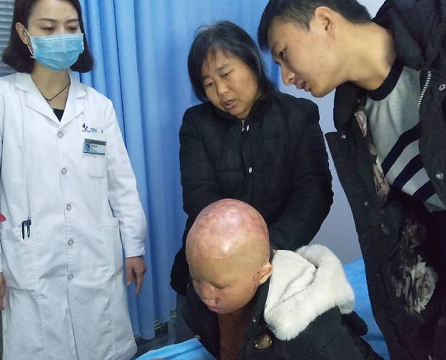 不忘初欣,奕起守护|9958「奕起祛疤童爱救助基金」救助进行中