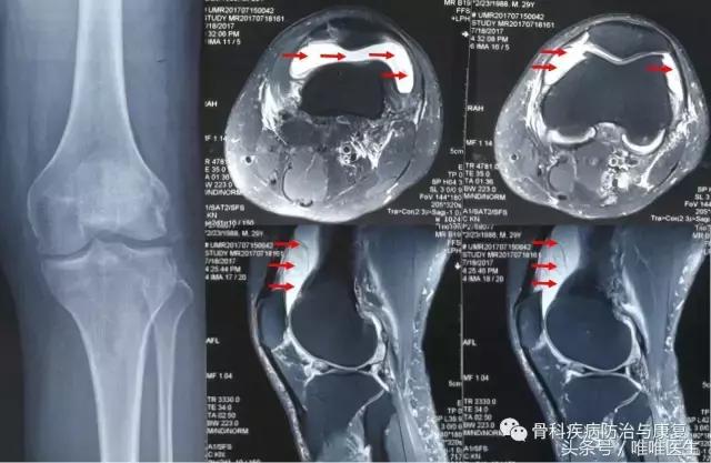 武汉骨科滑膜炎去哪里看最好,骨科专家滑膜炎是什么症状