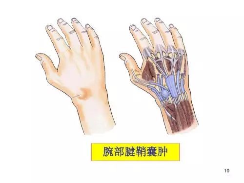 手腕血管周围有肿块是怎么回事,手腕上有突出的肿块能按摩下去吗