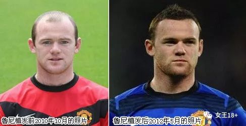 怎么防治中年男士发际线后移,18岁男发际线后移怎么补救