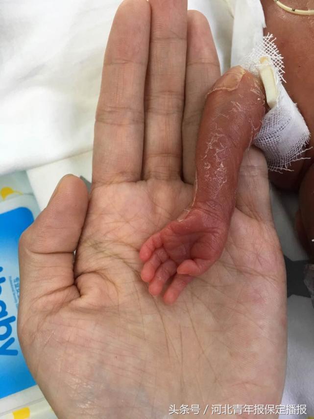 保定新生婴儿出生,生长受限的早产儿刚出生的照片