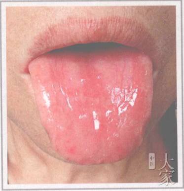 舌诊剥苔,小儿怎样看舌苔辨病症