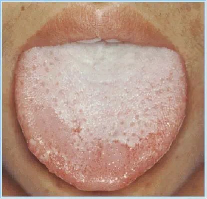 舌诊剥苔,小儿怎样看舌苔辨病症