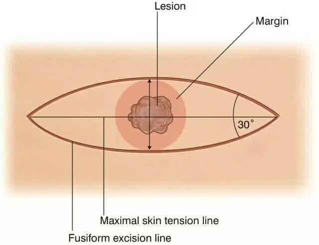 像小瘤一样的痣是什么,有个像疤一样的痣