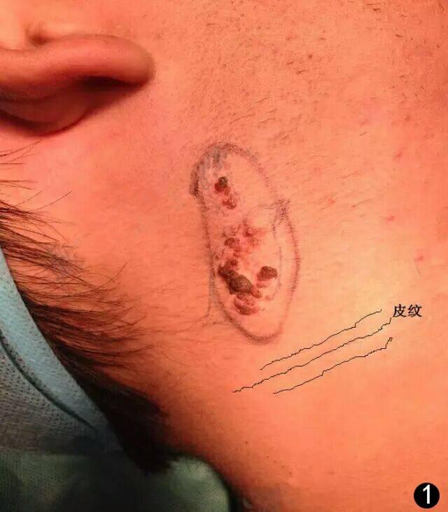 像小瘤一样的痣是什么,有个像疤一样的痣