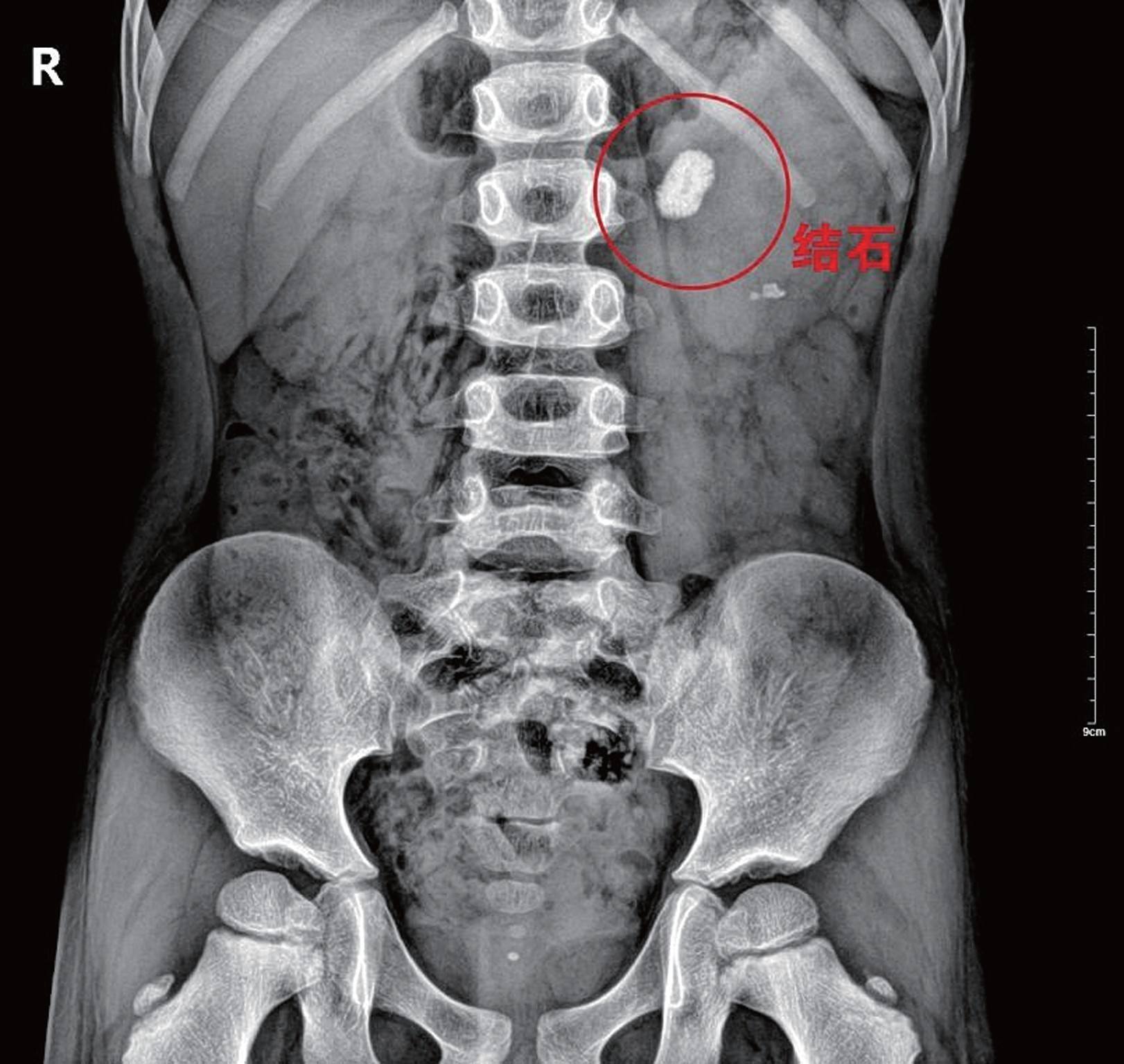 家长一定要注意孩子缺钙的问题,家长过度担心焦虑孩子健康