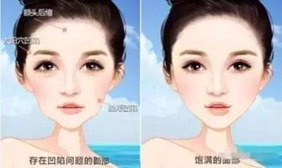 自体脂肪填充会下垂和移位吗,自体脂肪填充脸部后会自己消失吗