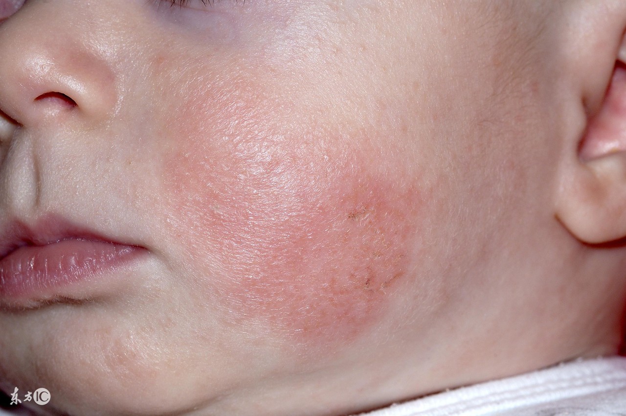 婴幼儿湿疹大作战!各种宝宝湿疹药膏面霜测评!(宝妈亲测有效)