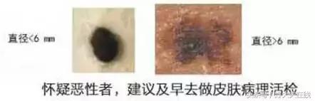 黑色胎记手术切除后还会癌变吗,孩子脸上有棕褐色胎记会癌变吗