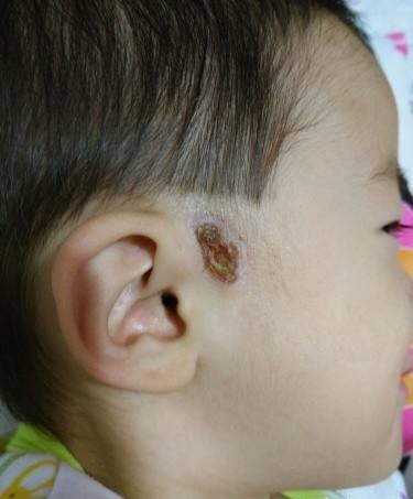 宝宝眼睑发炎里面有脓点,宝宝眼皮经常肿最后化脓