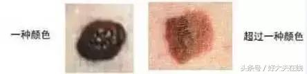 黑色胎记手术切除后还会癌变吗,孩子脸上有棕褐色胎记会癌变吗