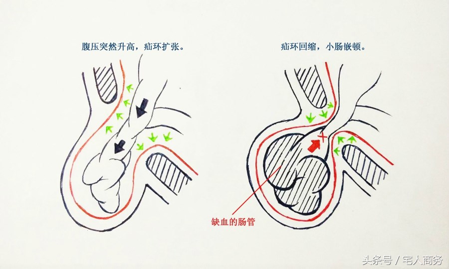 疝气病能吃中药治疗吗,小肠疝气最好的食疗方法
