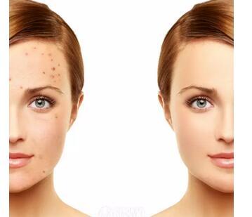 七个祛痘印的小窍门，快快收藏吧！