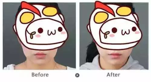 丰下巴用玻尿酸好还是自体脂肪好,玻尿酸丰下巴后要注意哪些问题