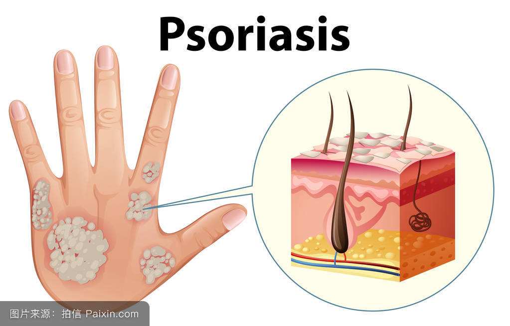 银屑病头皮,银屑病图片