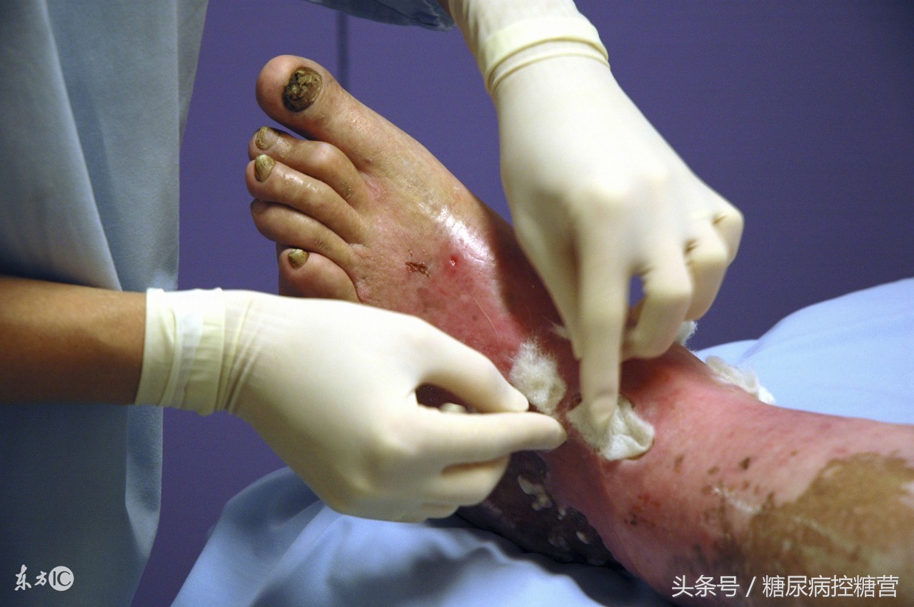 糖友夏天运动大汗淋漓好吗,糖友运动如何才能达到最好的效果