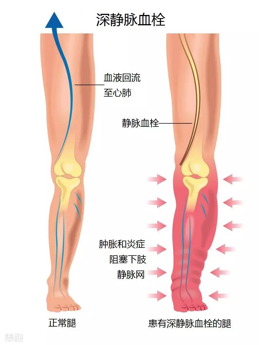 压缩袜是什么,压缩裤的真相