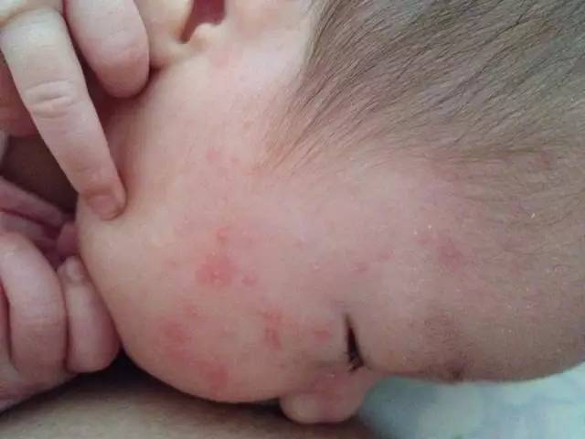 宝宝湿疹痒痒的有什么办法治好吗,宝宝湿疹好了皮肤痒怎么办