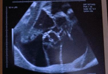 宝宝胎动把妈妈肚子踢哭,胎儿胎动像踢连环腿一样