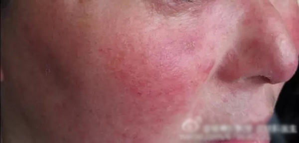酒渣鼻严重怎么彻底治疗,酒渣鼻难道真的看不好吗