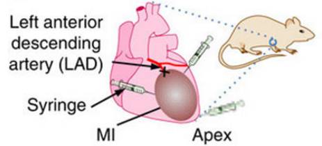 心肌梗死干细胞治疗,自身骨髓干细胞移植治疗心肌梗死