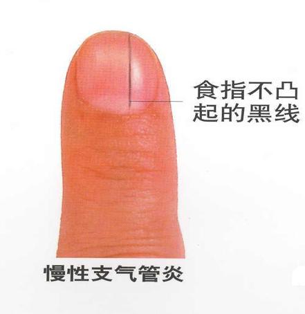 小小指甲,小小的指甲隐藏大大的健康秘密