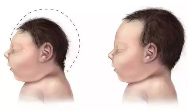 寨卡病毒引发致命并发症,寨卡病毒会导致胎儿出现什么情况