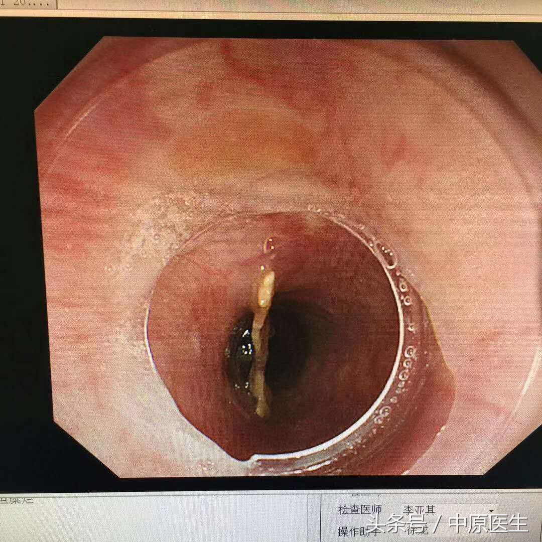 吃东西不小心被卡怎么办,小鱼刺卡到食管怎么办