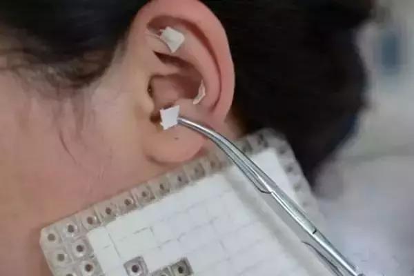 耳穴压豆治疗冠心病论文,冠心病胸胀痛买什么耳穴贴