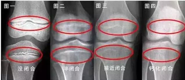 幼儿青枝骨折最快多久拆石膏,孩子青枝骨折需要治疗吗