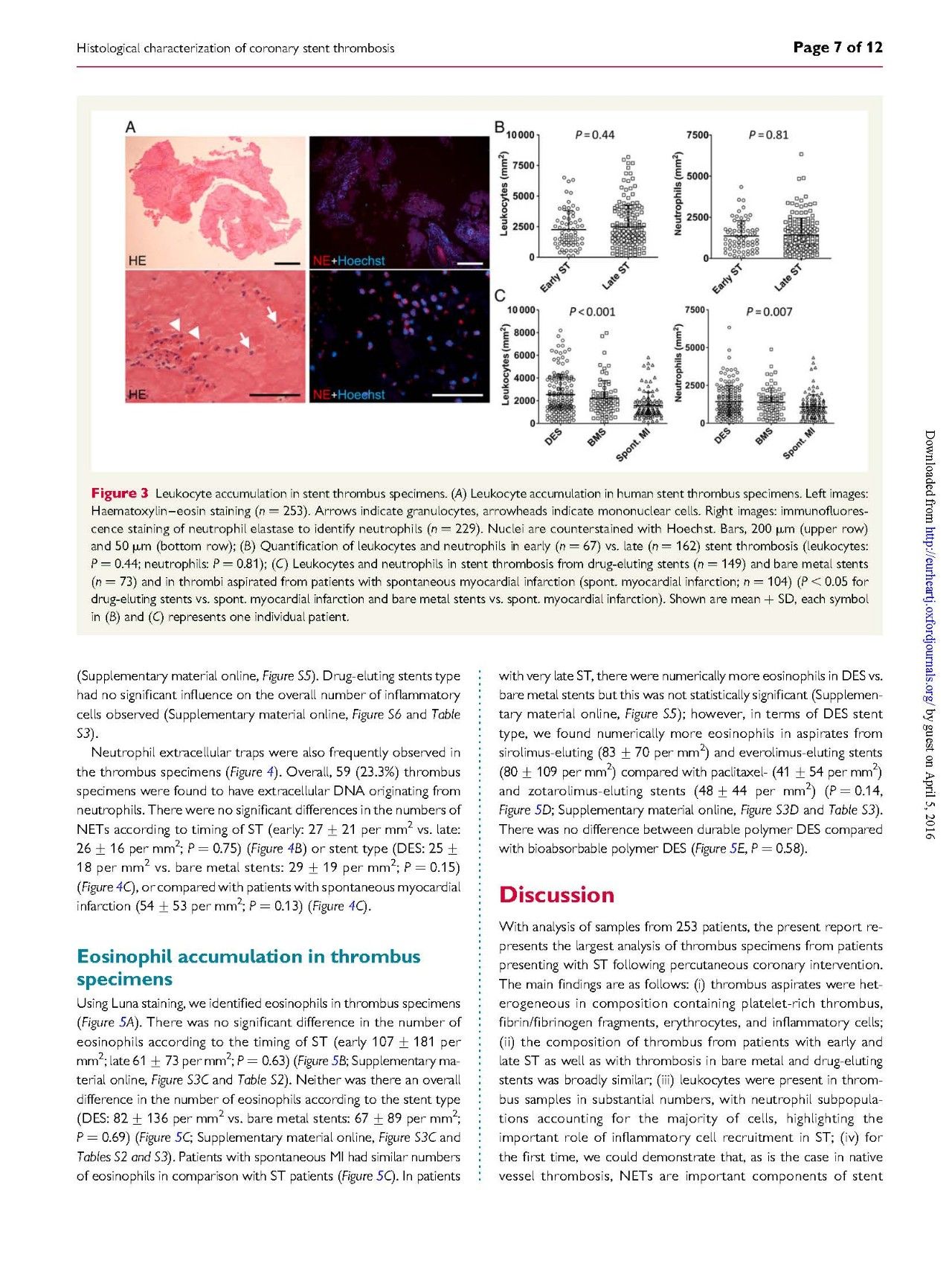 支架内血栓怎么处理,支架内血栓的原因及表现