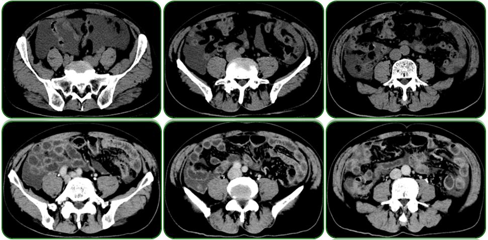 同为腹水，命运迥异