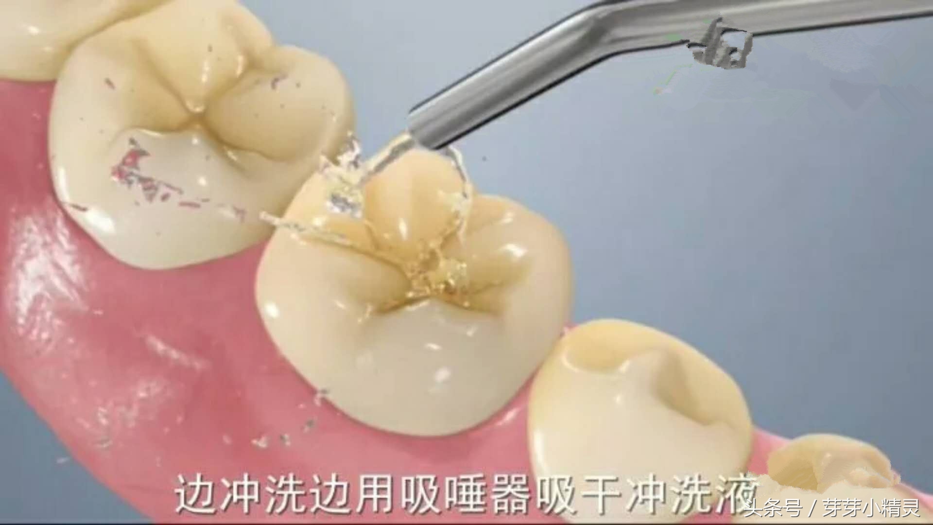 窝沟封闭注意事项,虫牙可以做窝沟封闭吗