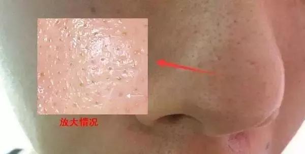 男士去除黑头粉刺的洗面奶排行榜,男士祛黑头粉刺收缩毛孔产品推荐