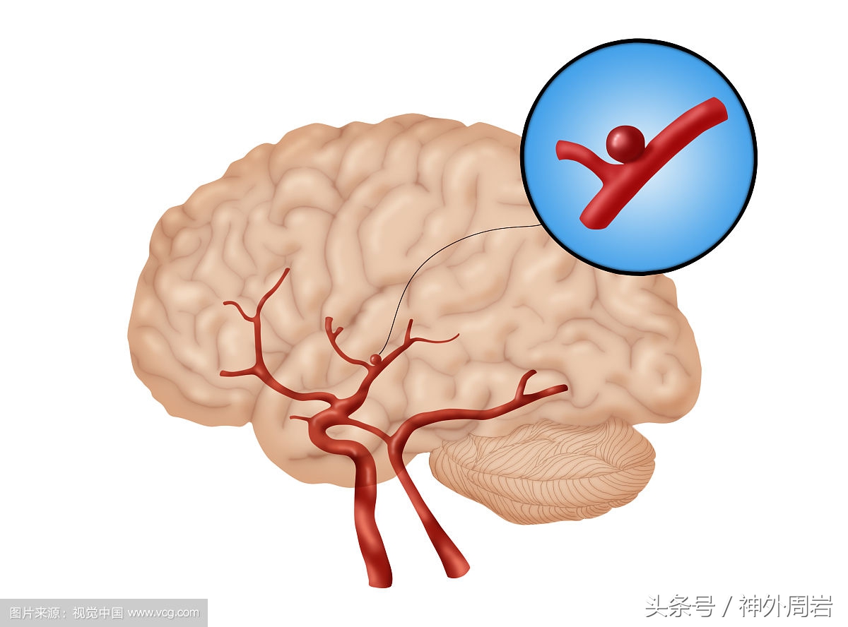 妊娠反应头疼怎么回事,妊娠高血压产后头痛严重吗