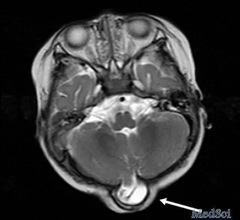 b超误诊脑膨出的概率,bmj临床特征