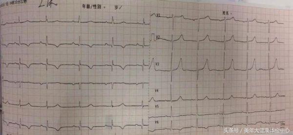 病例分享:服用华法林的月经期女性发生急性心肌梗死1例